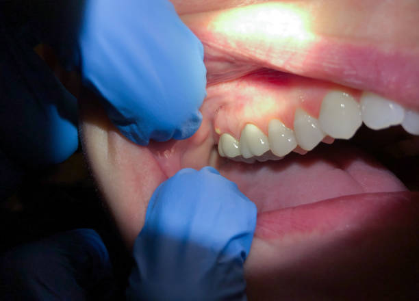 Best Emergency Gum Treatment in Pepperdine University, CA