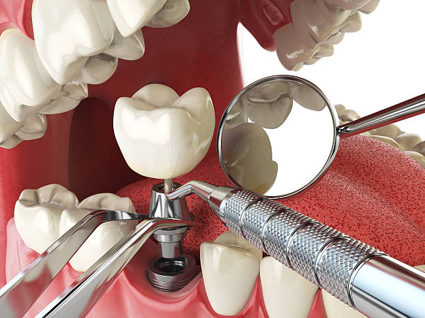 Best Urgent Care for Lost Fillings or Crowns in Pepperdine University, CA